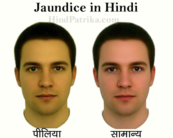 Jaundice in Hindi